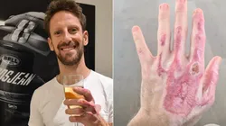 Romain Grosjean mostra mão atingida pelo fogo em acidente