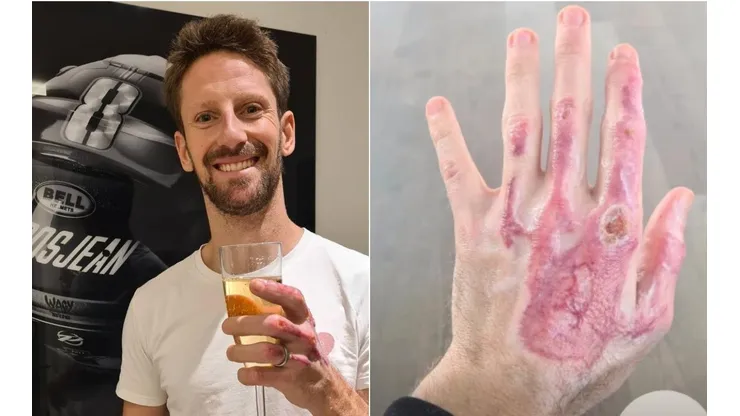 Romain Grosjean mostra mão atingida pelo fogo em acidente