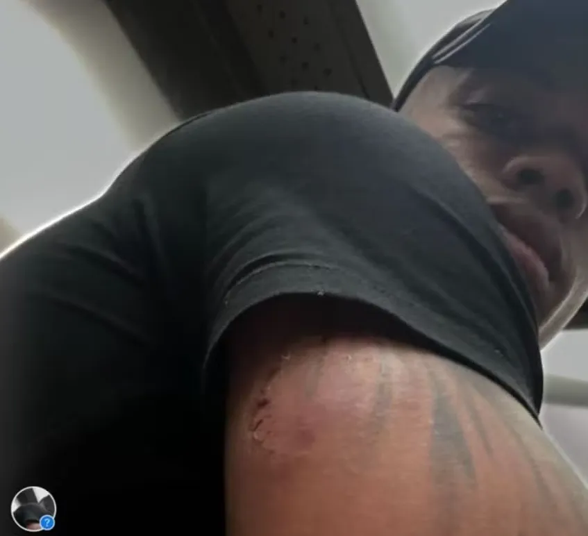 Caio Paulista apresenta braço mordido e alega ter sido por Clara – Foto: Arquivo Pessoal